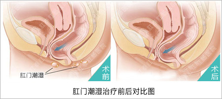 肛门潮湿