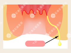 肛瘘