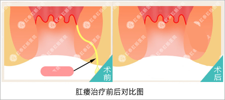 肛瘘